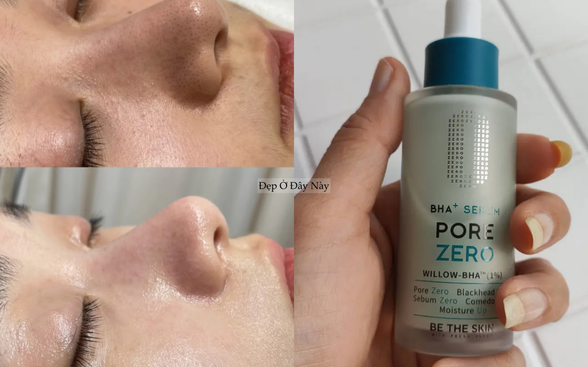 Chuyên gia chỉ ra: Có tới 4 loại lỗ chân lông to và cách khắc phục hiệu quả nhất - Ảnh 4.