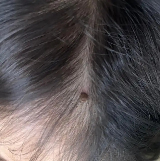 Bé 1 tuổi bị ve chui vào da đầu, bác sĩ cảnh báo: Tuyệt đối không tự ý giật ra - Ảnh 1.