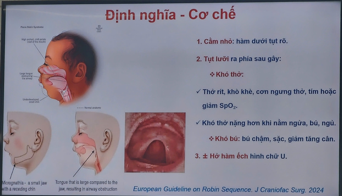 Kh&oacute; thở sau sinh, tưởng b&eacute; chỉ bị đờm nhưng lại mắc hội chứng Pierre Robin - Ảnh 3.