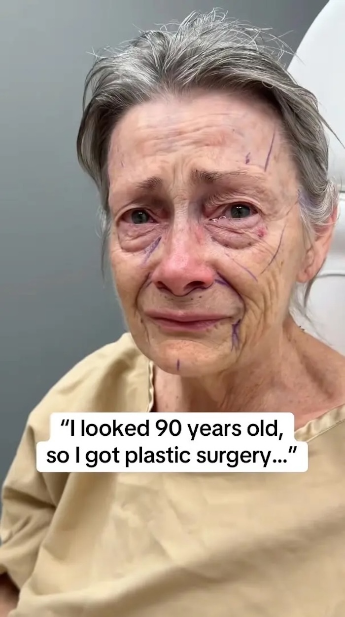 Cụ b&agrave; 70 tuổi trẻ h&oacute;a kỳ diệu nhờ phẫu thuật căng da tại Beverly Hills - Ảnh 1.