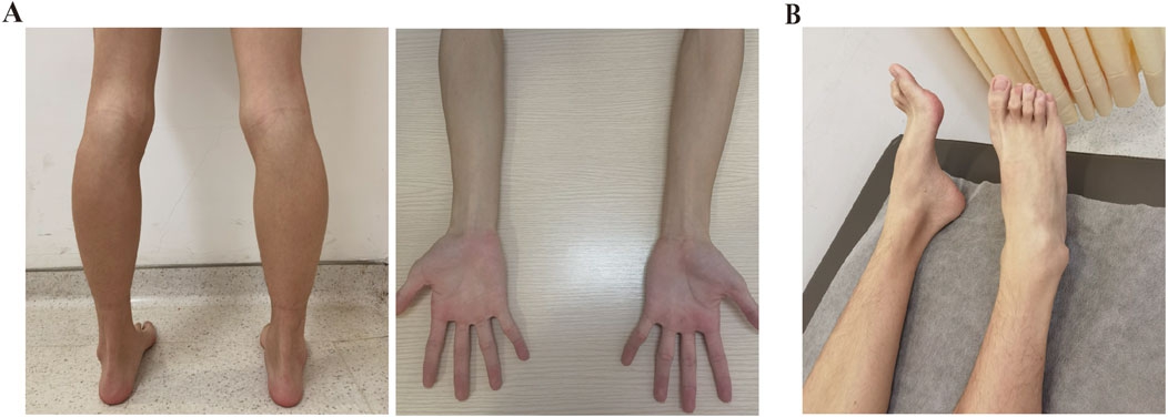 Nghiên cứu khoa học về bệnh Charcot-Marie-Tooth và hy vọng điều trị
