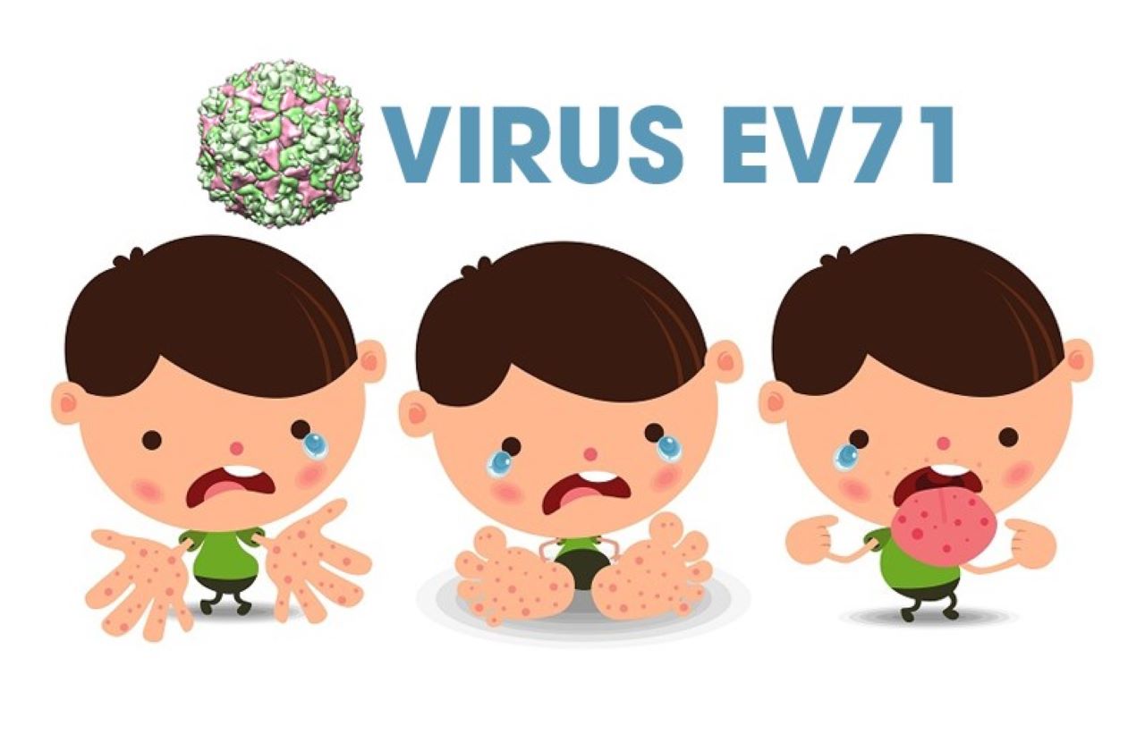 Virus mới khiến trẻ mắc tay chân miệng chuyển nặng, tử vong rất nhanh là gì? Làm cách nào để phòng tránh? - Ảnh 4.