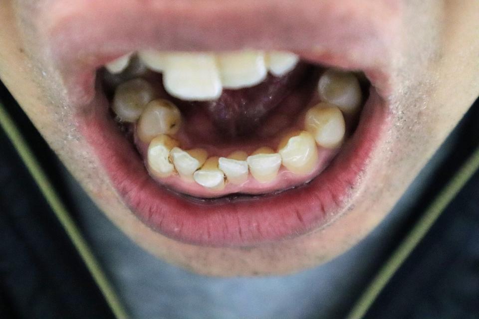 Vẫn bị h&ocirc;i miệng d&ugrave; đ&aacute;nh răng bao nhi&ecirc;u lần đi nữa, b&aacute;c sĩ tiết lộ 