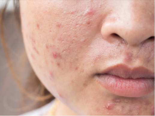 Routine chăm s&oacute;c da dầu mụn đơn giản tại nh&agrave;: 3 bước khoa học c&ugrave;ng Actidem - Ảnh 1.