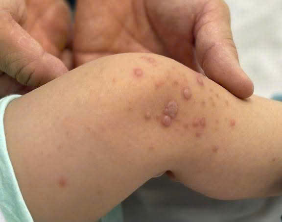 Bệnh tay ch&acirc;n miệng tăng nhanh, b&aacute;c sĩ cảnh b&aacute;o n&oacute;ng - Ảnh 1.