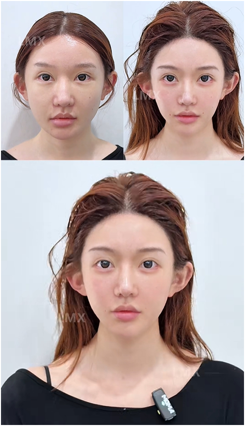 T&igrave;m hiểu xu hướng cao hộp sọ ở Trung Quốc v&agrave; những nguy hiểm sức khỏe tiềm ẩn - Ảnh 1.