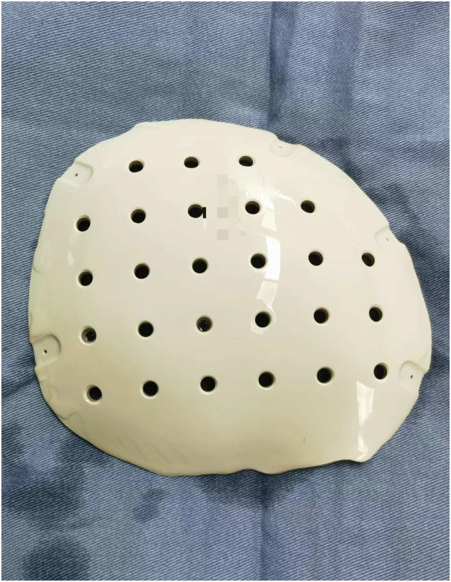 T&igrave;m hiểu xu hướng cao hộp sọ ở Trung Quốc v&agrave; những nguy hiểm sức khỏe tiềm ẩn - Ảnh 6.