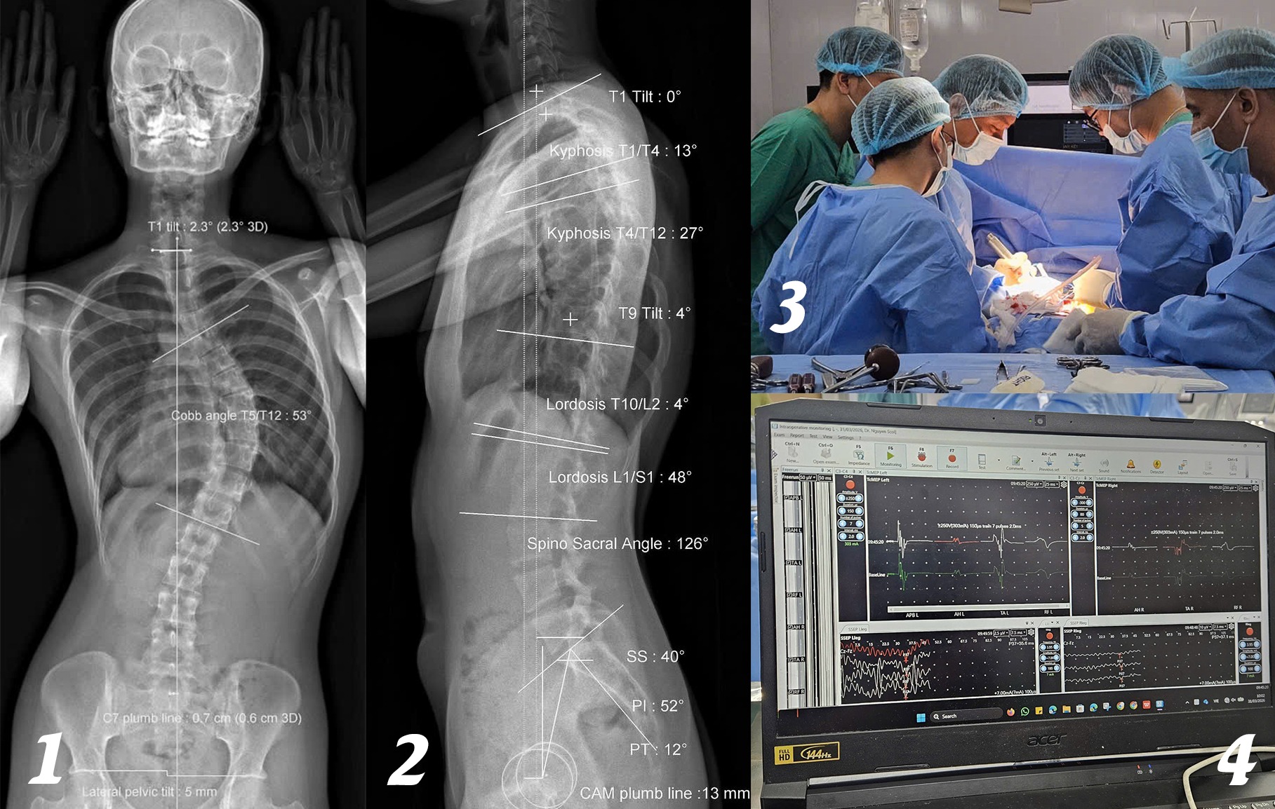 Soi gương thấy lưng c&oacute; dấu hiệu lạ, c&ocirc; g&aacute;i 18 tuổi sốc khi biết cột sống đ&atilde; cong 53 độ - Ảnh 1.