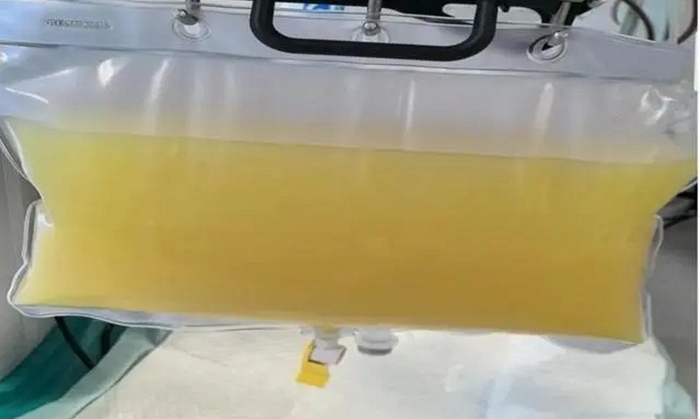 C&ocirc; g&aacute;i soi gương thấy lưng c&oacute; dấu hiệu lạ, kh&ocirc;ng ngờ cột sống đ&atilde; cong 53 độ - Ảnh 4.