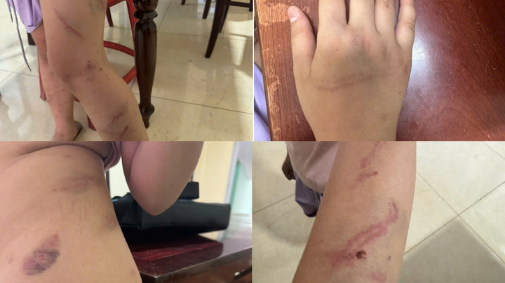 X&aacute;c minh vụ b&eacute; g&aacute;i 9 tuổi c&oacute; 34 vết bầm nghi bạo h&agrave;nh ở Đắk Lắk - Ảnh 1.