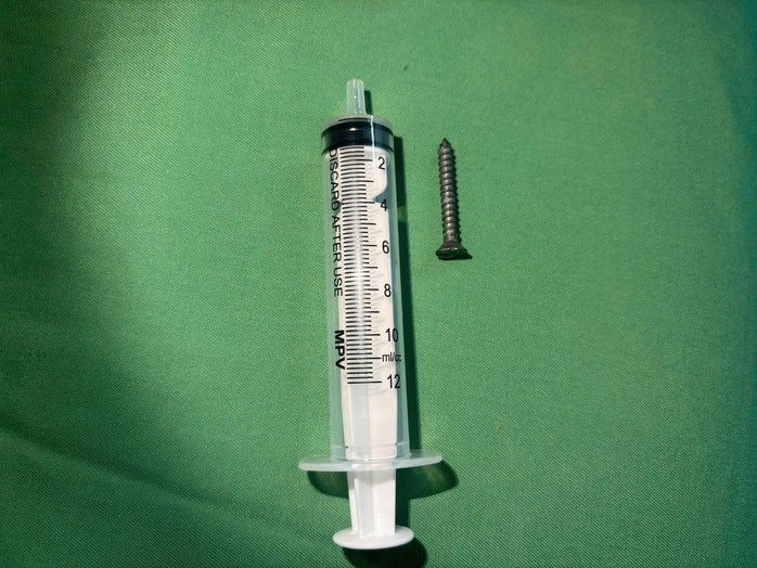 Dị vật nguy hiểm trong dạ dày bệnh nhi 21 tháng tuổi - Ảnh 1.