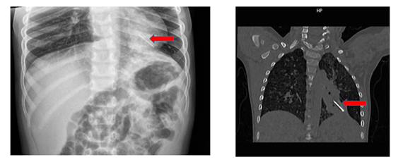 H&oacute;c kẽm nhung 2 cm: C&acirc;u chuyện của b&eacute; trai 3 tuổi được mổ khẩn cấp - Ảnh 1.