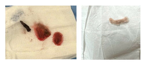 H&oacute;c kẽm nhung 2 cm: C&acirc;u chuyện của b&eacute; trai 3 tuổi được mổ khẩn cấp - Ảnh 2.