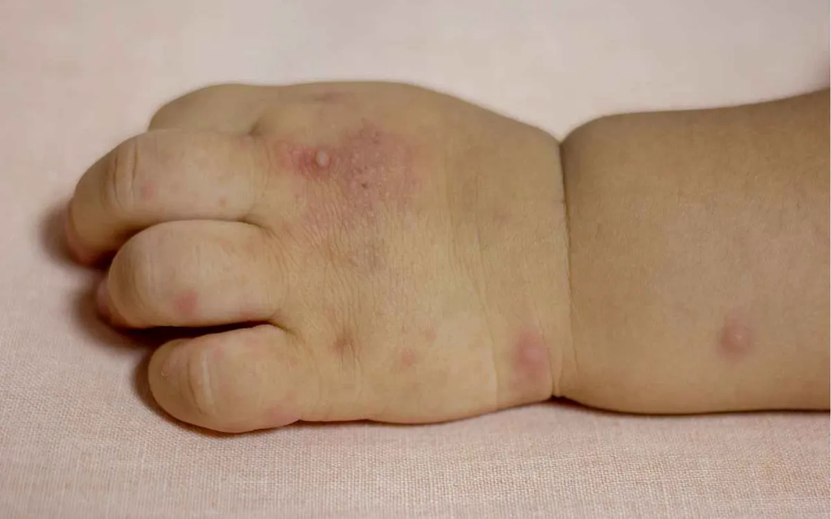 Bệnh tay ch&acirc;n miệng l&acirc;y lan trong trường học, cha mẹ cần l&agrave;m g&igrave;? - Ảnh 1.