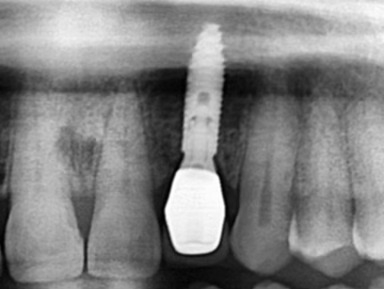 Phục hình răng implant tự nhiên như răng thật tại Nha Khoa Như Ngọc