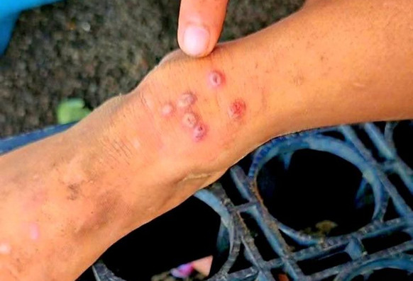 Bộ Y tế cảnh b&aacute;o về bệnh 