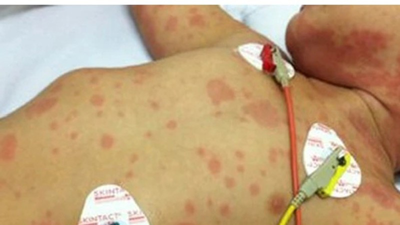 Th&ecirc;m 2 ca mắc vi&ecirc;m n&atilde;o m&ocirc; cầu, 1 trẻ tử vong: Cảnh b&aacute;o n&oacute;ng người d&acirc;n cần l&agrave;m ngay 1 việc - Ảnh 2.