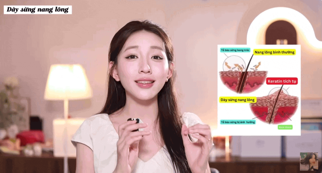 Hơn chục năm bị dày sừng nang lông, cô nàng U30 chỉ cách  - Ảnh 1.