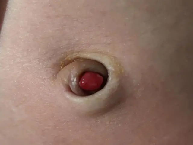 Bé sơ sinh mọc “cục thịt nhỏ” ở rốn, còn rỉ dịch: Đây không phải viêm rốn thông thường - Ảnh 1.