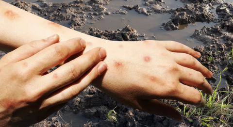 Bộ Y tế cảnh b&aacute;o về bệnh 