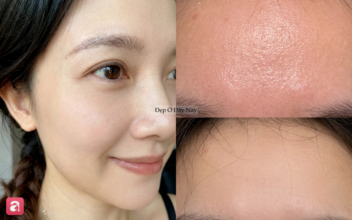Loại serum 