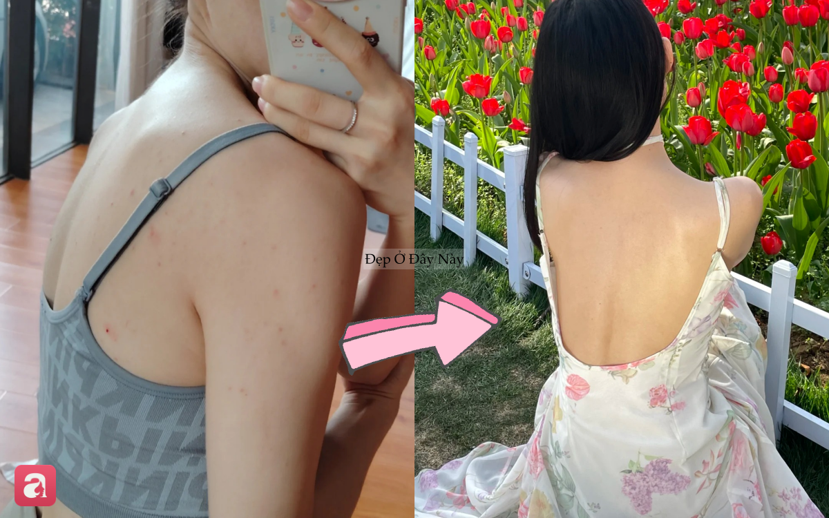 Mụn lưng &ldquo;bay sạch&rdquo;, da mịn như em b&eacute; với c&aacute;ch chăm da đơn giản của n&agrave;ng blogger Trung Quốc - Ảnh 1.