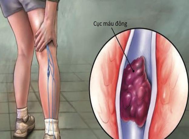 Kiễng ch&acirc;n gi&uacute;p ph&ograve;ng ngừa huyết khối: Danh y x&aacute;c nhận l&agrave; thật, th&ecirc;m 2 động t&aacute;c kh&aacute;c cũng hiệu quả - Ảnh 1.