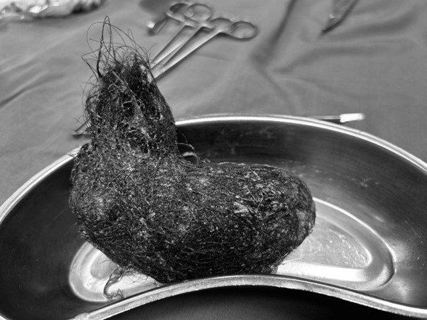 B&eacute; g&aacute;i 7 tuổi bị Hội chứng Rapunzel: C&acirc;u chuyện y tế r&ugrave;ng m&igrave;nh từ Bệnh viện Quảng Ng&atilde;i - Ảnh 1.