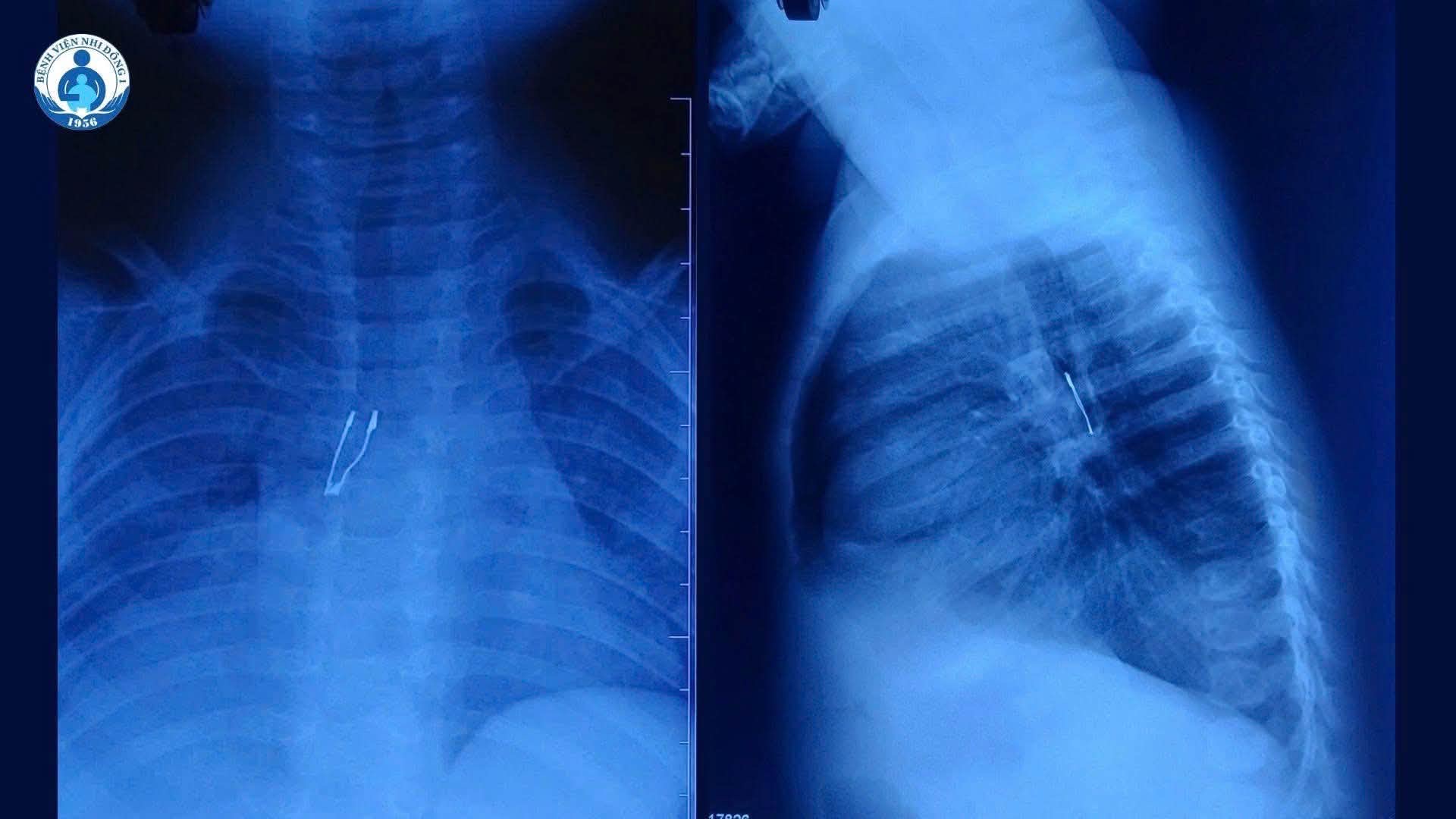 B&aacute;c sĩ gắp đ&egrave;n LED trong phế quản b&eacute; 9 th&aacute;ng tuổi tại Bệnh viện Nhi Đồng 1 - Ảnh 1.