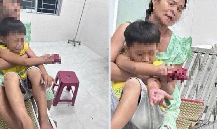 Ch&aacute;u b&eacute; 9 tuổi bị dập b&agrave;n tay nghi do điện thọai ph&aacute;t nổ khi sạc pin - Ảnh 1.