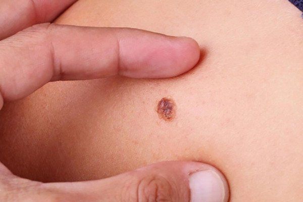 Di căn nhanh, tỉ lệ tử vong cao! C&ocirc; g&aacute;i 25 tuổi qua đời chỉ 5 th&aacute;ng sau khi chẩn đo&aacute;n ung thư, b&aacute;c sĩ đưa ra lời cảnh b&aacute;o hệ trọng - Ảnh 3.