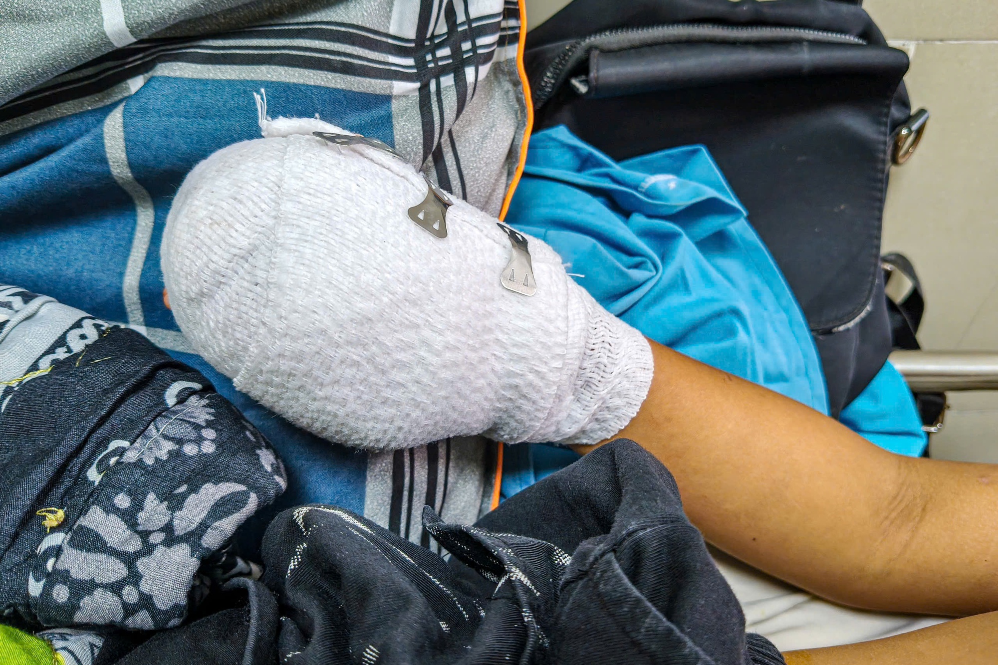 Ch&aacute;u b&eacute; 9 tuổi bị dập b&agrave;n tay nghi do điện thọai ph&aacute;t nổ khi sạc pin - Ảnh 2.