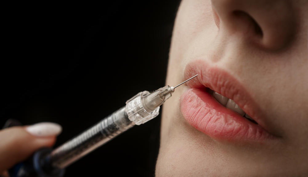 Từ h&ocirc;m nay ti&ecirc;m filler th&igrave; đi chơi dịp lễ 30/4 c&oacute; kịp đẹp kh&ocirc;ng?- Ảnh 1.