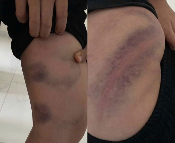 B&eacute; trai Bắc Ninh bị cha đ&aacute;nh bầm t&iacute;m v&igrave; lười học g&acirc;y phẫn nộ dư luận - Ảnh 1.