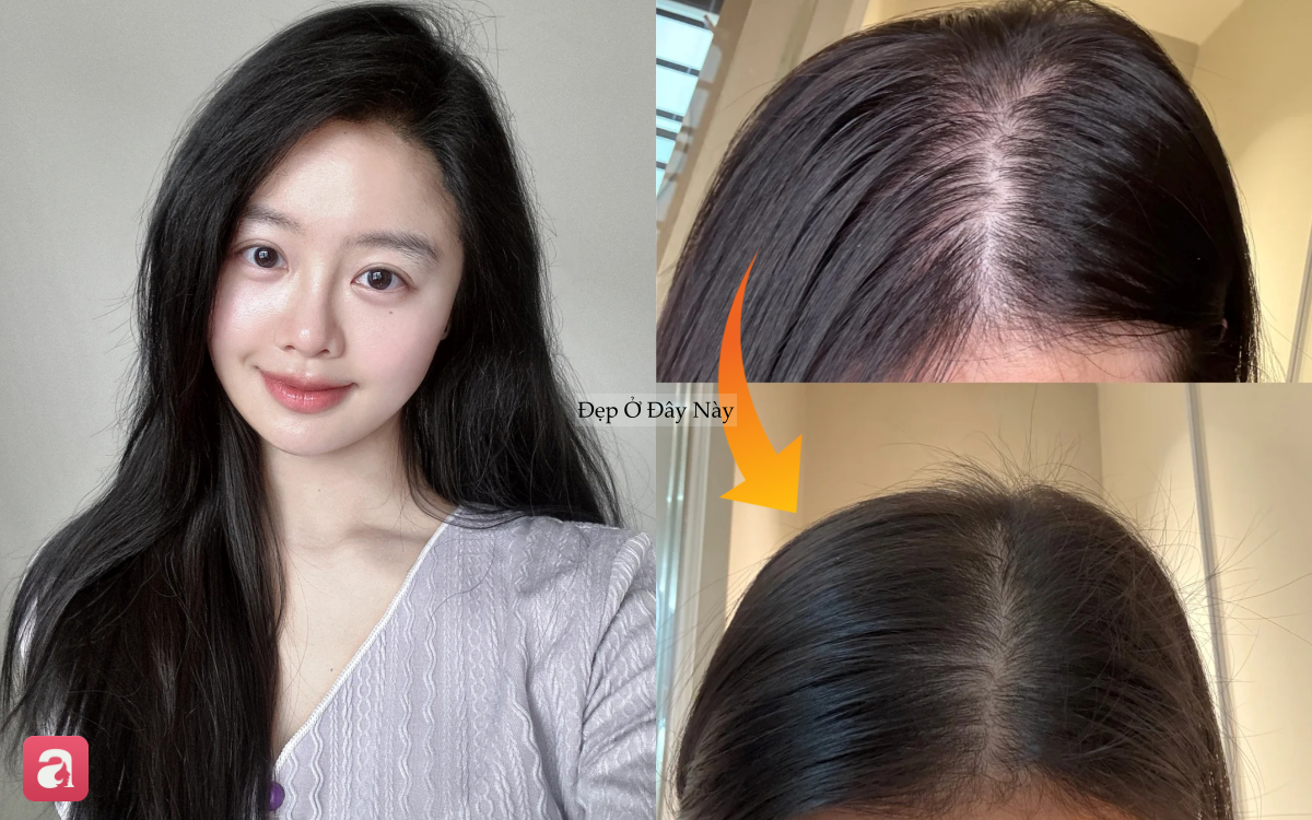 T&oacute;c rụng từng nắm vẫn 