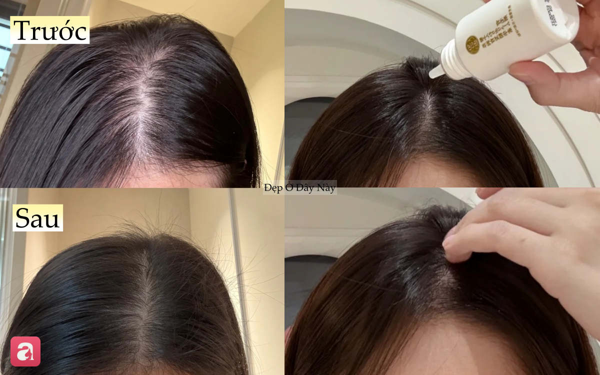 T&oacute;c rụng từng nắm vẫn 