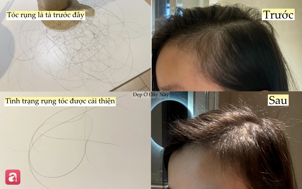 T&oacute;c rụng từng nắm vẫn 