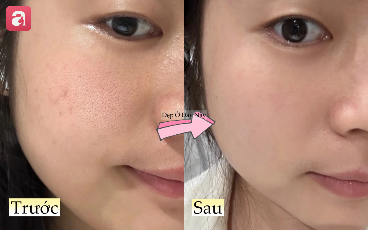 L&agrave;n da sần s&ugrave;i, lỗ ch&acirc;n l&ocirc;ng to của n&agrave;ng blogger đ&atilde; thay đổi ho&agrave;n to&agrave;n nhờ c&aacute;ch chăm da &iacute;t người ch&uacute; &yacute; - Ảnh 6.