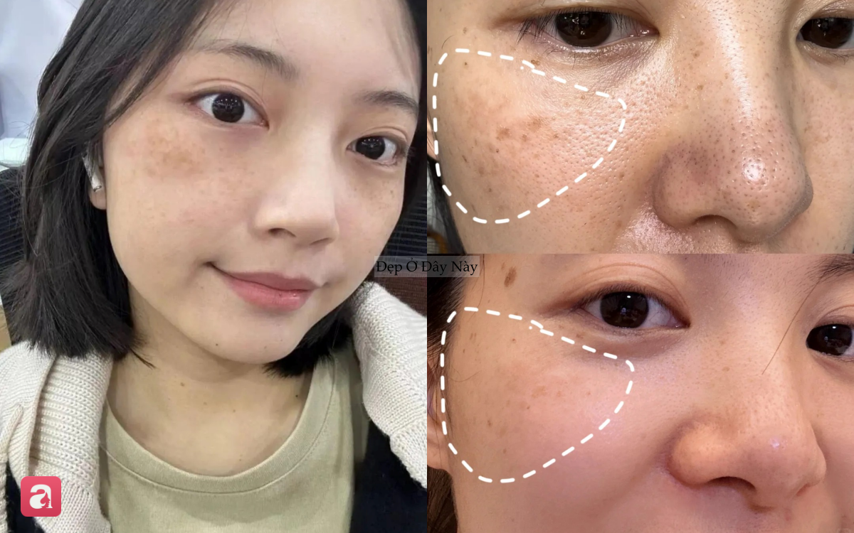 Tiến sĩ da liễu tiết lộ 5 c&aacute;ch giảm th&acirc;m n&aacute;m tại nh&agrave; nhiều người bỏ qua - Ảnh 1.