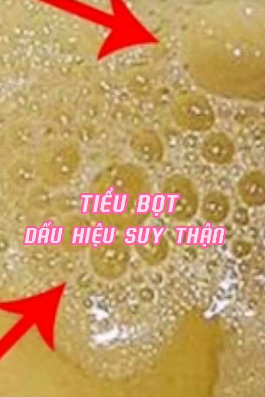 Đừng l&ecirc;n TikTok t&igrave;m c&acirc;u trả lời, nếu thấy nước tiểu c&oacute; những dấu hiệu n&agrave;y th&igrave; cần đi kh&aacute;m ngay kẻo hỏng thận - Ảnh 1.