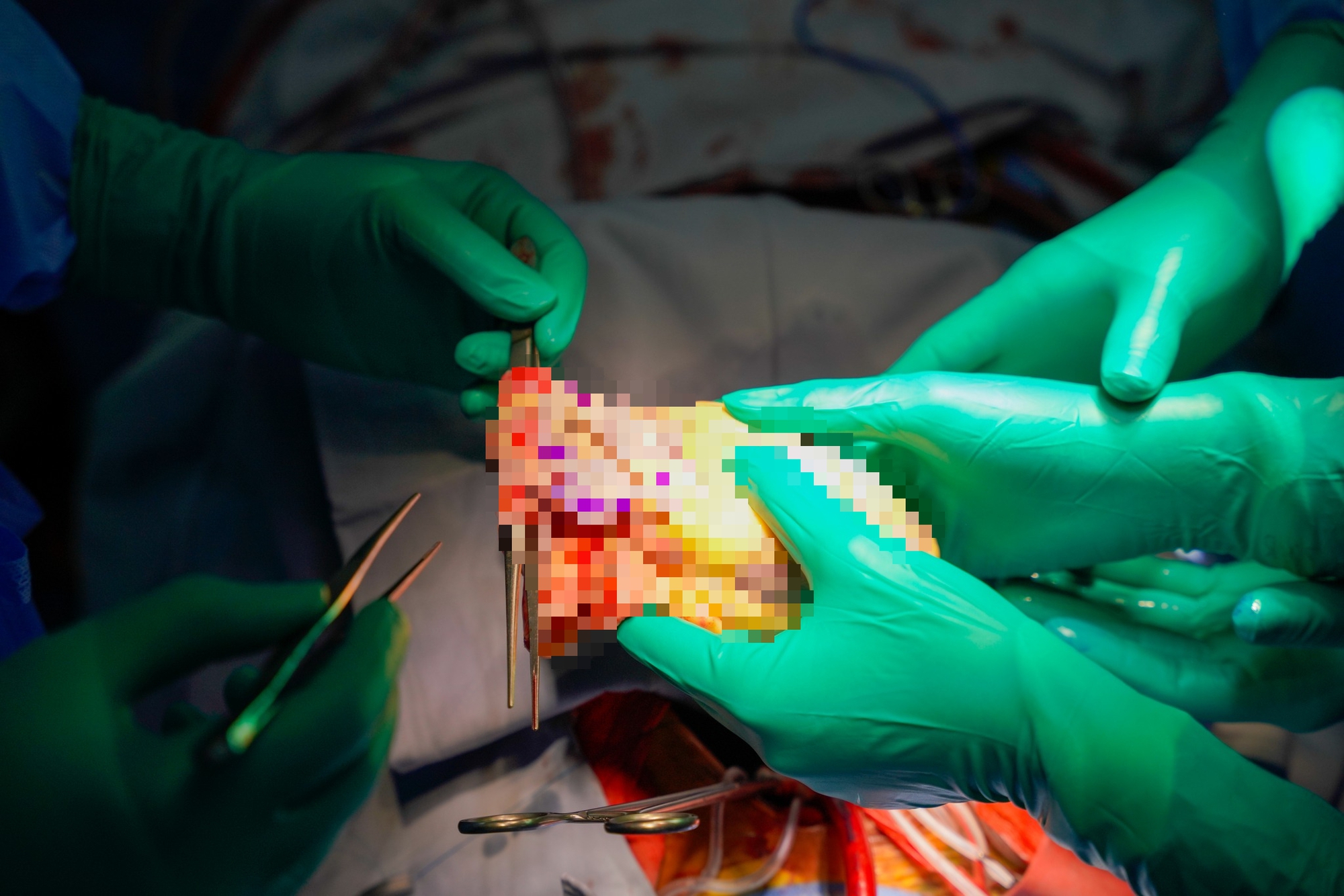 Tr&aacute;i tim bỗng đập trở lại trong lồng ngực người nhận gần ngừng tim, chạy ECMO suốt 8 ng&agrave;y, BS: 