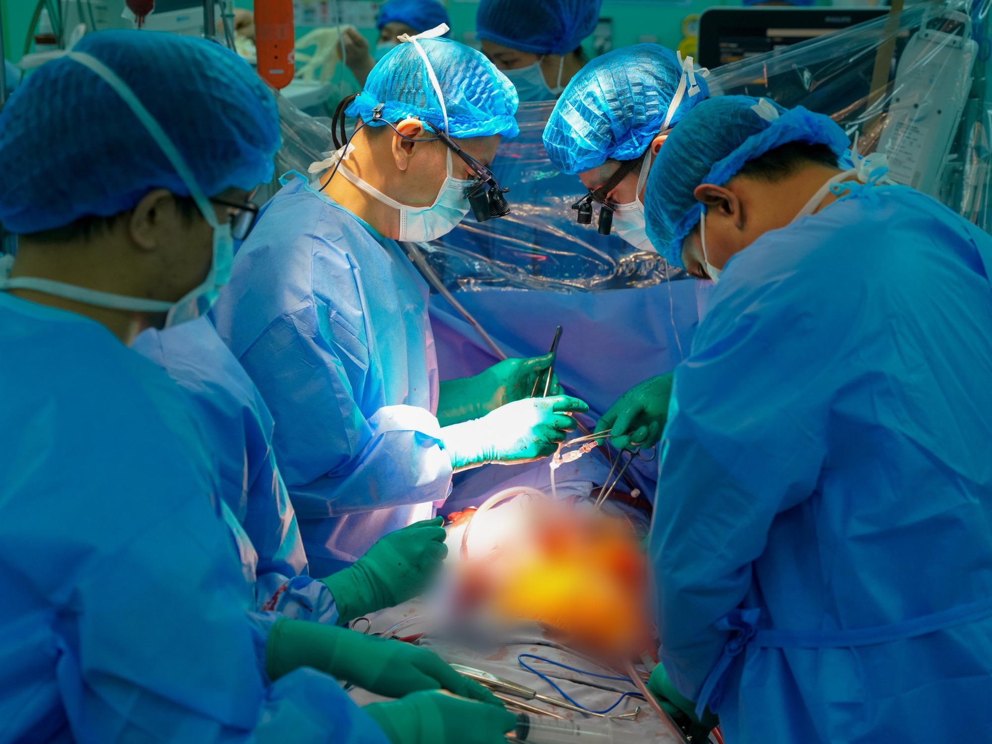 Tr&aacute;i tim bỗng đập trở lại trong lồng ngực người nhận gần ngừng tim, chạy ECMO suốt 8 ng&agrave;y, BS: 
