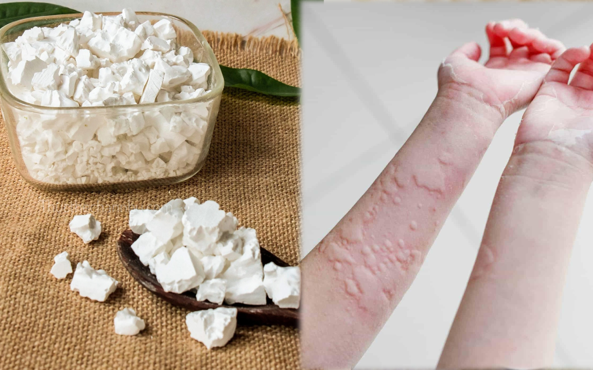 C&ocirc; g&aacute;i 23 tuổi ở TP.HCM bật kh&oacute;c khi c&oacute; phản ứng với giang mai: 
