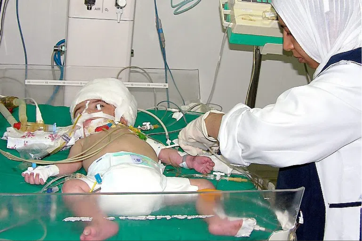 B&eacute; g&aacute;i Manar Maged: Cuộc sống kỳ diệu v&agrave; dị tật hiếm gặp của trẻ sơ sinh - Ảnh 2.