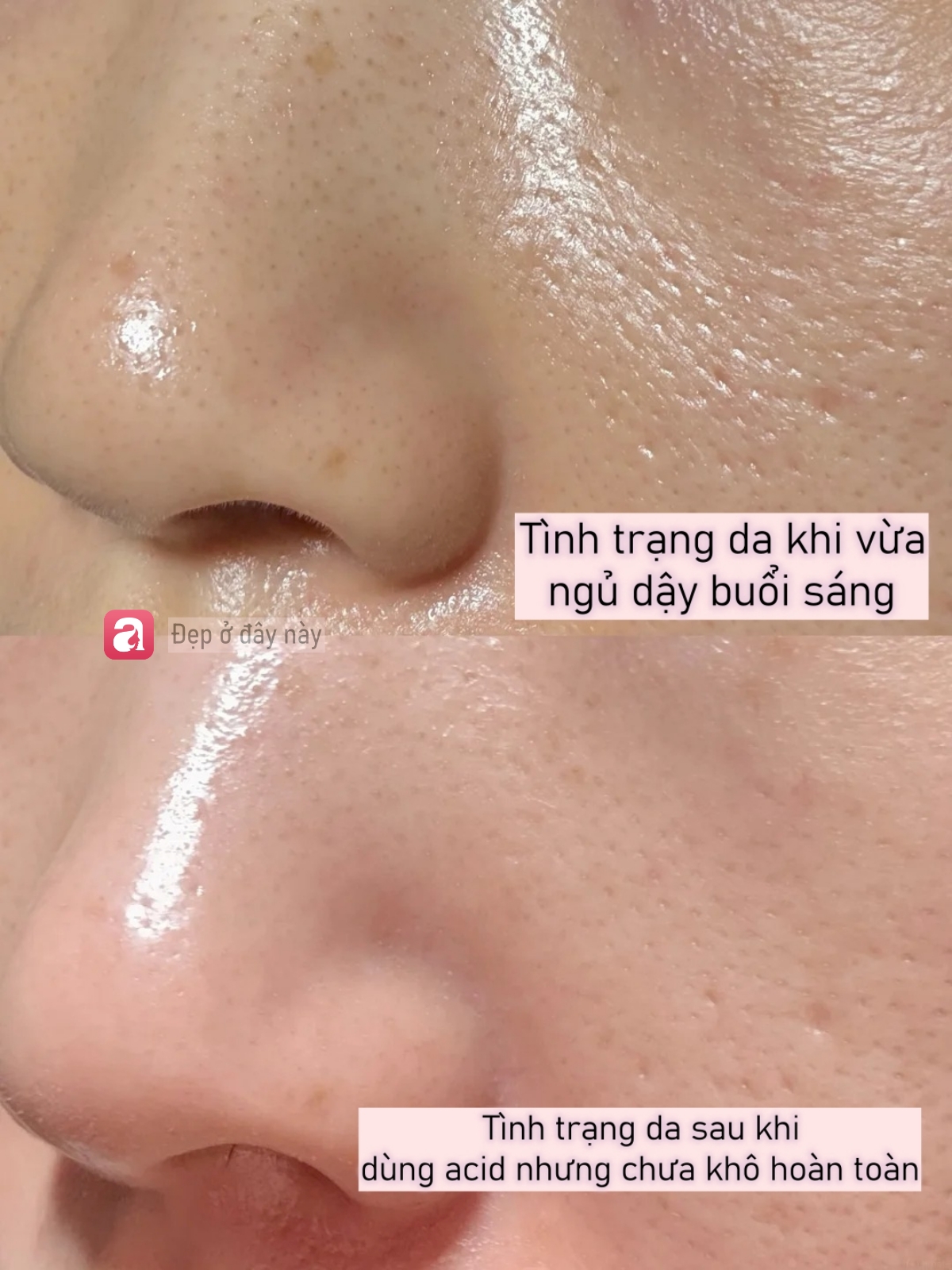 T&ocirc;i d&ugrave;ng acid nồng độ 30% lần thứ 3: Da vẫn b&oacute;ng mịn nhưng đỡ đỏ r&aacute;t hơn hẳn - Ảnh 7.