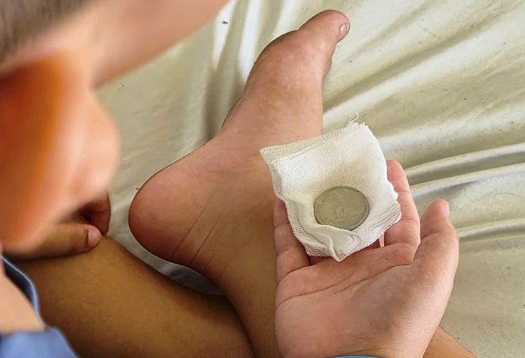 B&eacute; trai 7 tuổi n&ocirc;n &oacute;i nghi nuốt dị vật nguy hiểm , b&aacute;c sĩ gắp th&agrave;nh c&ocirc;ng - Ảnh 2.
