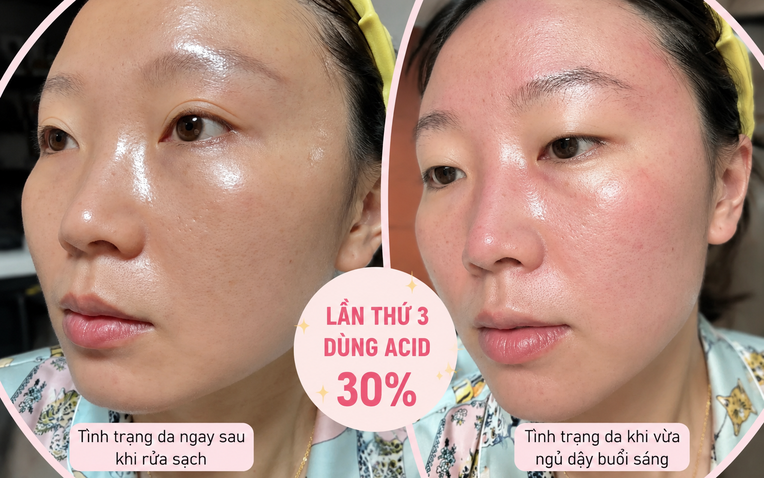 T&ocirc;i d&ugrave;ng acid nồng độ 30% lần thứ 3: Da vẫn b&oacute;ng mịn nhưng đỡ đỏ r&aacute;t hơn hẳn - Ảnh 1.