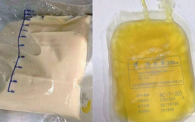 9 năm &ldquo;nghiện&rdquo; tr&agrave; sữa thay nước lọc, uống tới 3.000 cốc: Người phụ nữ biến hai quả thận th&agrave;nh... t&uacute;i đựng sỏi - Ảnh 2.