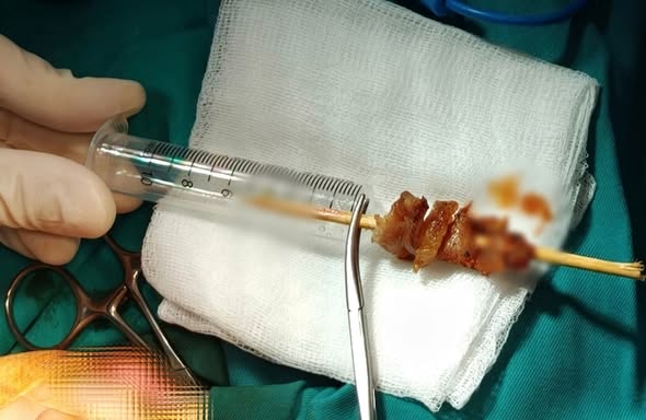 Liên tiếp xảy ra các vụ tai nạn liên quan đến que xiên: Từ bé gái suýt mù mắt đến bé trai bị đâm xuyên bàn tay - Ảnh 1.