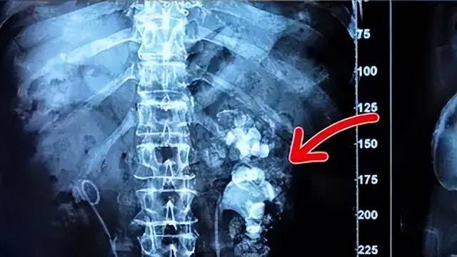 9 năm &ldquo;nghiện&rdquo; tr&agrave; sữa thay nước lọc, uống tới 3.000 cốc: Người phụ nữ biến hai quả thận th&agrave;nh... t&uacute;i đựng sỏi - Ảnh 1.